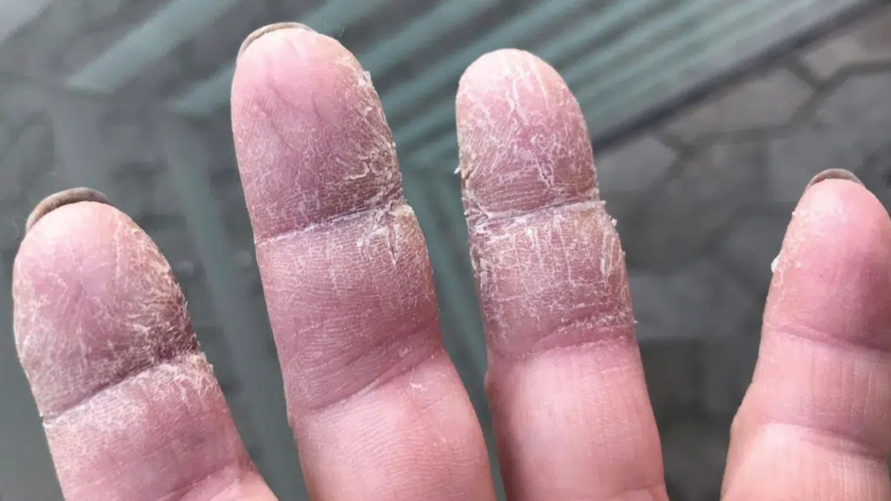 Problemhud på hænder