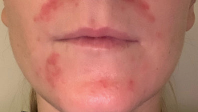 Rosacea
